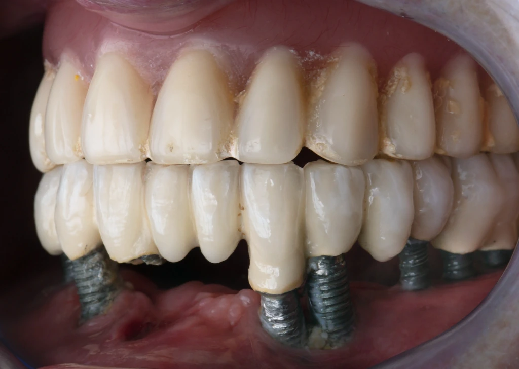 Does food get under all 4 dental implants? 